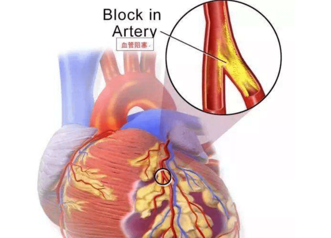 心脏|百年协和讲堂 | 如何区分心绞痛和心梗？专家教你“找不同”