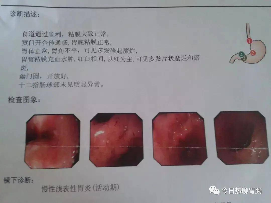 胃镜单解读:浅表性胃炎,胃黏膜的7大特征