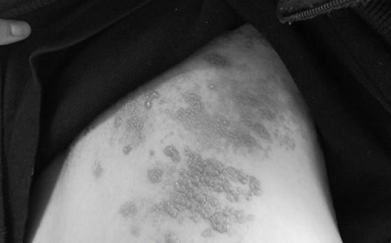 疱疹怎么样才能止痛 38cb5858a880444485ad724570b9d7dc.png