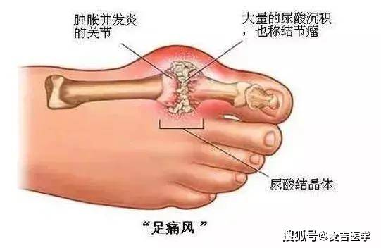 血糖血压血脂尿酸都高能吃什么 f99b10940b0047c780ede31848601478.jpeg