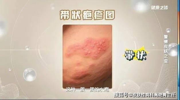 但却容易被忽视的皮肤之变,包括带状疱疹,病毒疣,光线性角化等