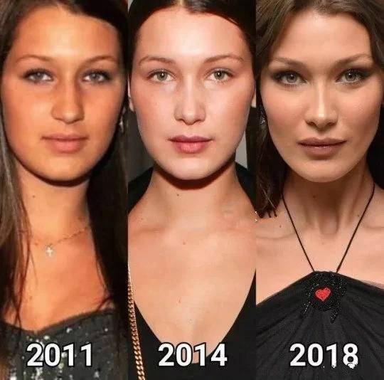 鼻子|别再羡慕欧美立体颜了！朱莉的精致翘鼻是整的，她丰唇一年花16万