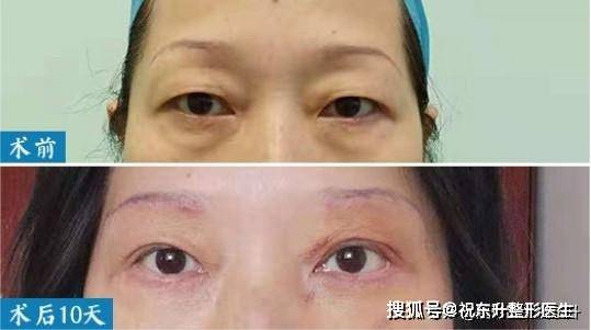 体验日记 | 眼皮老是"耷拉着",做完提眉手术后,感觉很