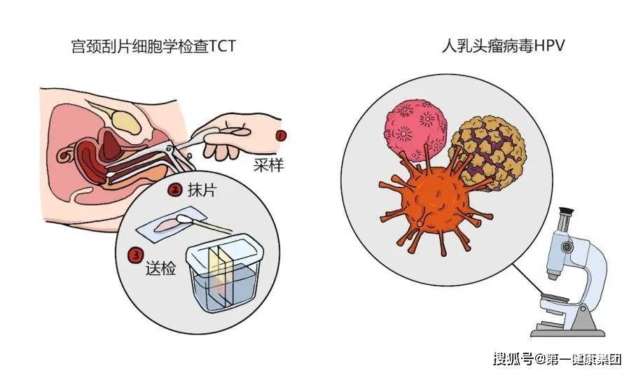 查tct还是hpv打了hpv疫苗还要做宫颈癌筛查吗