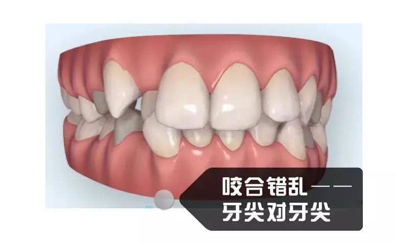 影响咀嚼功能 上下颌的咬合关系原本就有问题,却只做半口矫正,会导致