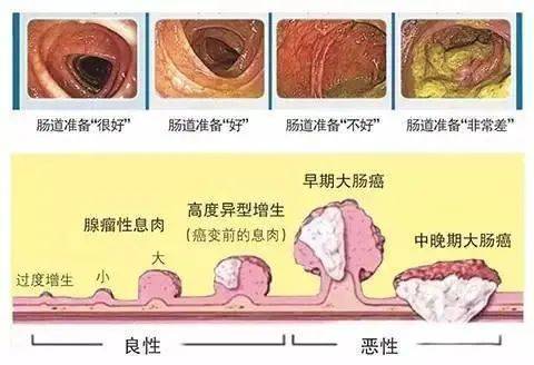 只要发现了肠息肉,把息肉切除了,就可以预防大肠癌,防止癌变.