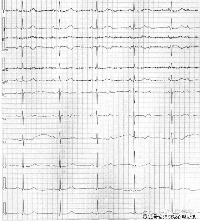 高度房室传导阻滞心电图