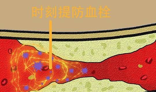 怎么能有效的消除血栓 d8e8503ba82b4d64953a6f993f82b019.jpeg