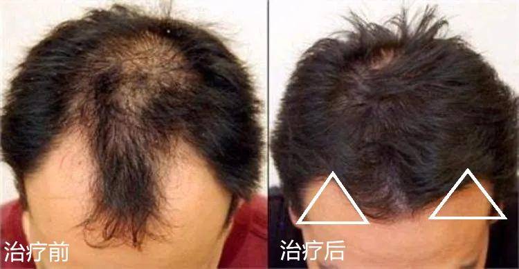 头发|娜扎消失的头发全回来了…这方法比鞠婧祎还高明！