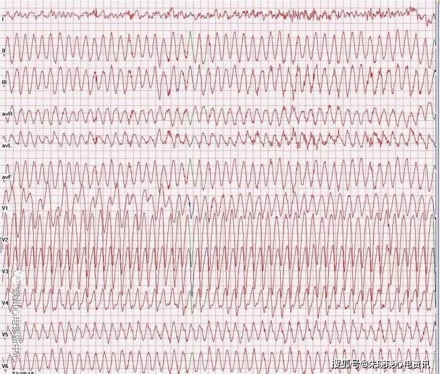 心电图检查:心室扑动呈正弦图形,波幅大而规则,频率150~300次/分,有