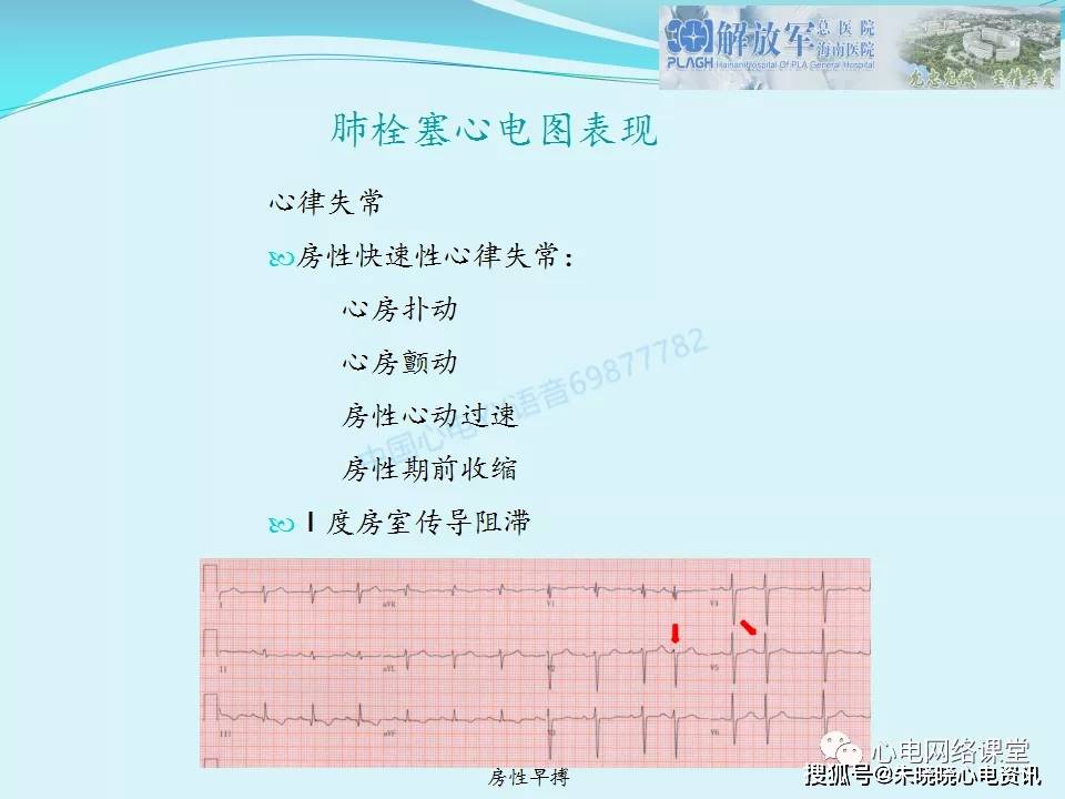 肺栓塞心电图表现及鉴别诊断