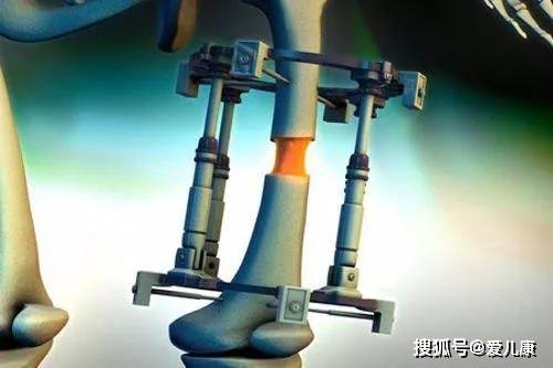 孩子|如今成了半残疾…这种「增高术」千万别给孩子做!当初花16万增高的孩子