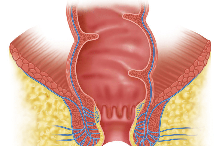 为什么会有痔疮这种东西 6cefcb025b2e4498920e48cda59e04b7.png