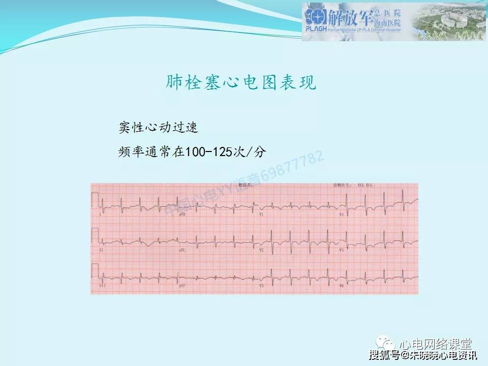 肺栓塞心电图表现及鉴别诊断