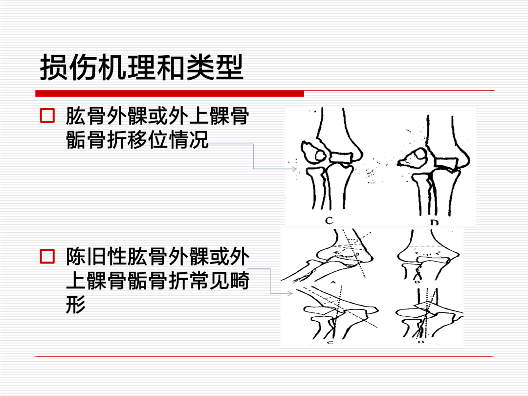 一文掌握肱骨远端骨折