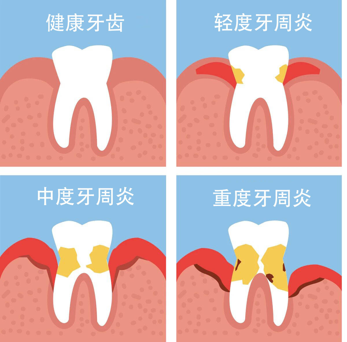 癌症,冠心病,糖尿病,肺炎都与这种口腔疾病有关!