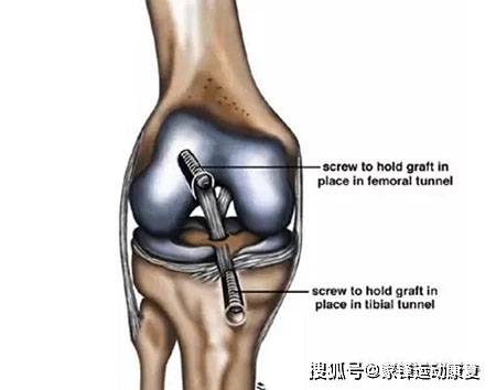 郑州体育老师关节韧带断裂康复纪录 异体韧带前叉重建术后8周康复接近全角