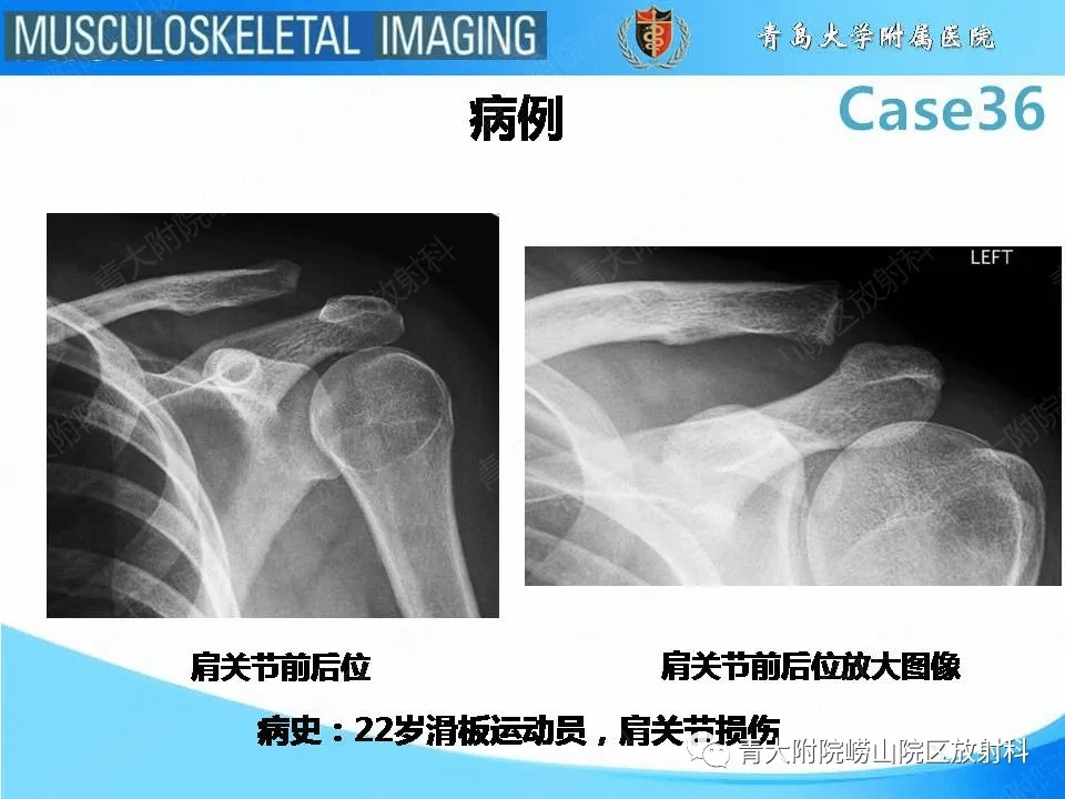 肩锁关节分离