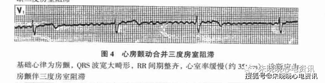 房颤时如果心室率极快(一般超过180bpm) 且qrs 波宽大畸形,必须考虑