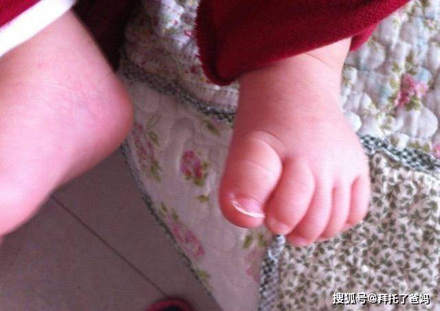 穿鞋|6岁孩子双脚变“畸形”，只因妈妈错误穿鞋方式，家长要引起重视