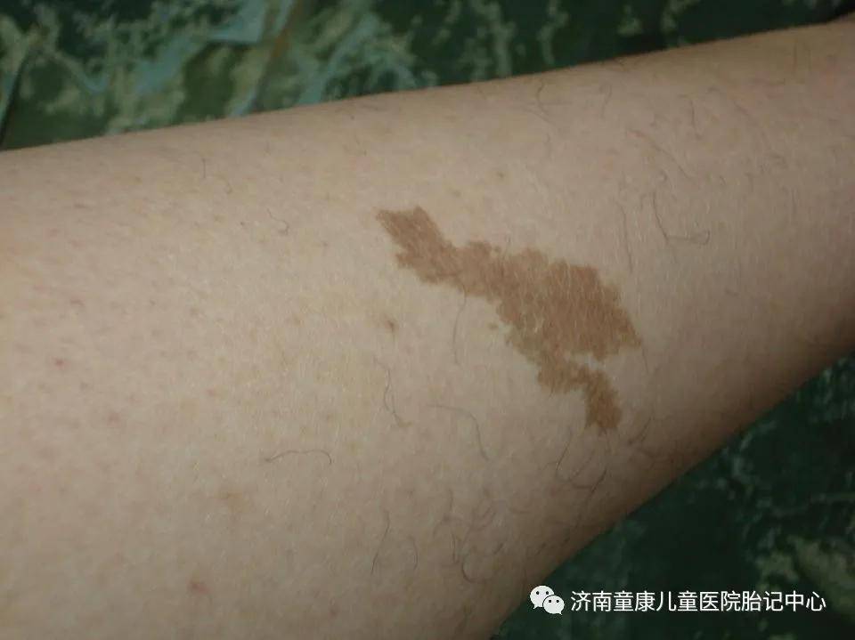 宝宝|宝宝长胎记难道是遗传？济南童康儿童医院