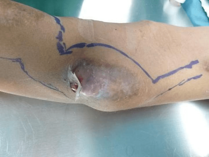 患者|南通六院切除鸭蛋大小血管瘤，重建尿毒症患者“生命线”