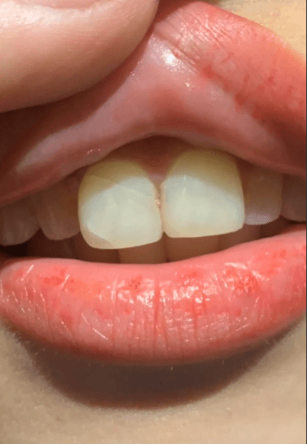 门牙裂了有什么好的方法补救吗?
