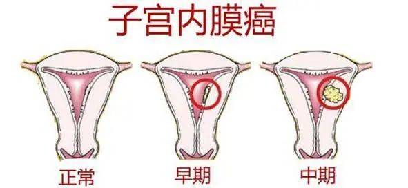 月经失调,离子宫内膜癌到底有多远?