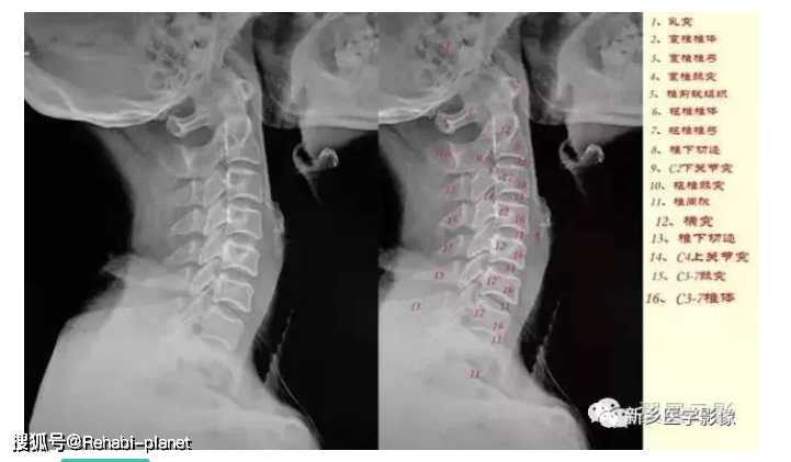 史上最详细的颈椎x线解剖 解读(经典收藏)