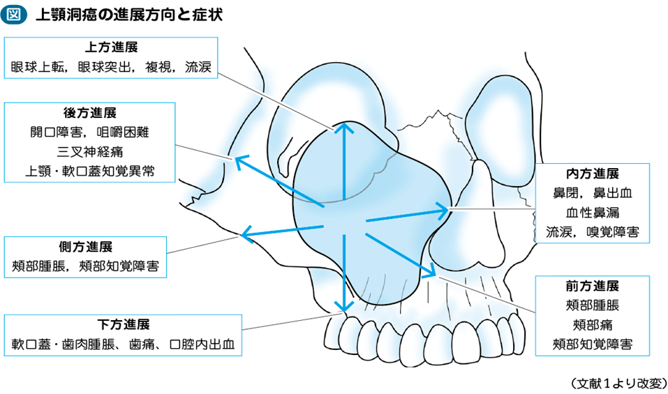 独家资讯上颌窦癌治疗干货整理