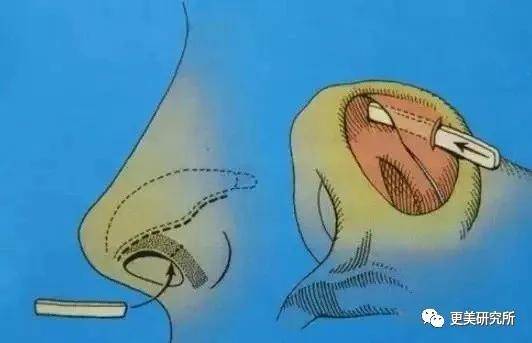 鼻尖|杨幂终于去修复鼻子了…