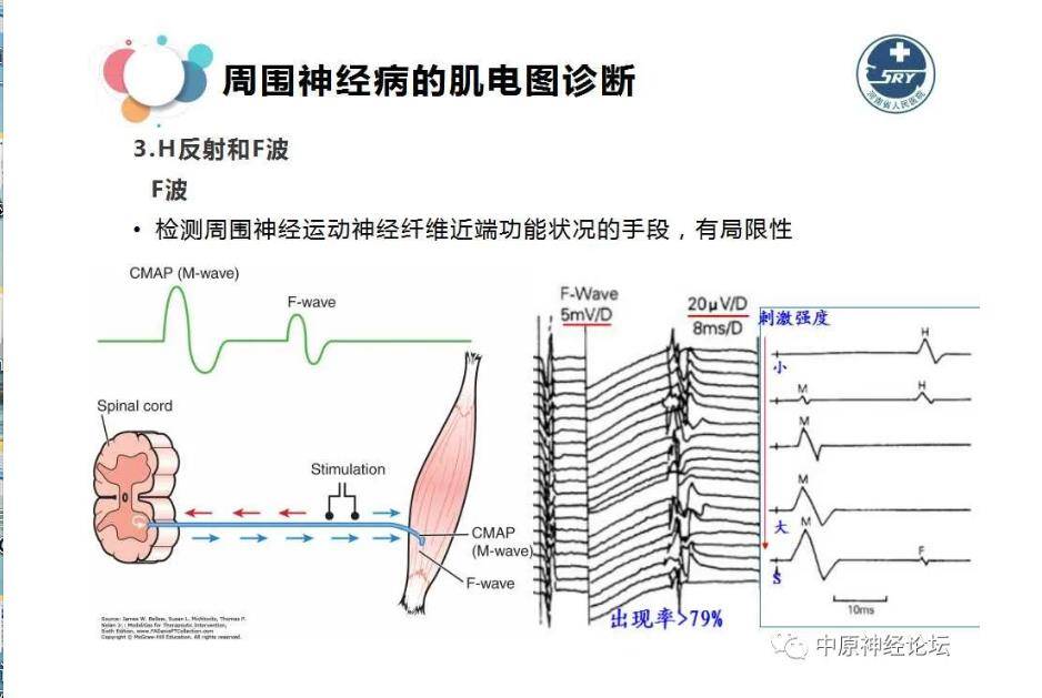 肌电图周围神经病与肌电图诊断