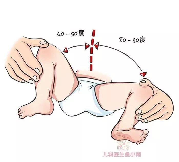 宝宝|宝宝腿纹臀纹不对称就是髋关节发育不良吗？为啥说越早发现越好