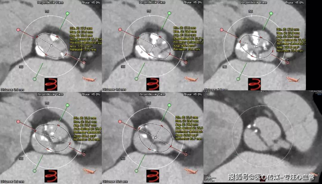 然而在8㎜,10㎜,即使是12㎜处,仍能看到左冠瓣叶,且已经非常接近stj