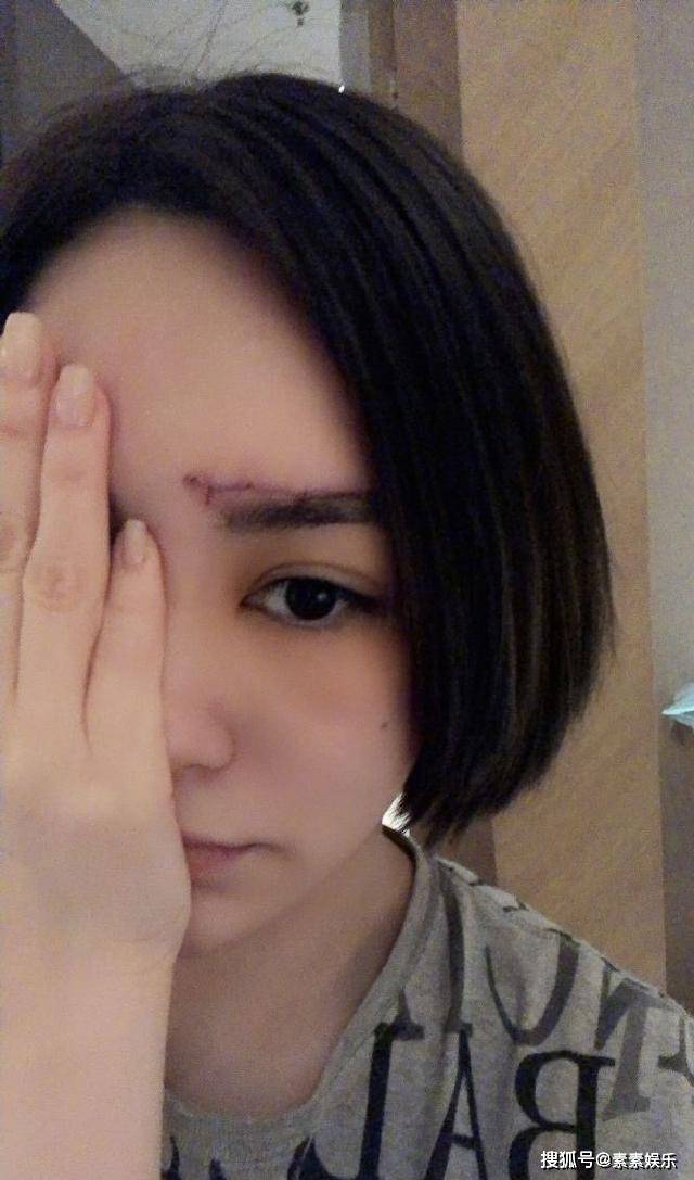阿娇公布伤口细节照：长长的伤痕清晰可见，看