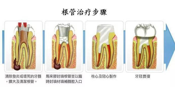 根管治疗之后的牙齿,除了及时戴上了牙冠,也需要我们多加注意,小心
