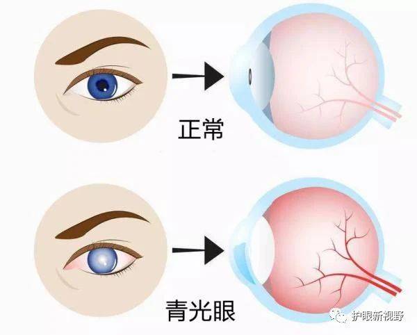 青光眼的自我诊断看看自己有没有这些症状吧