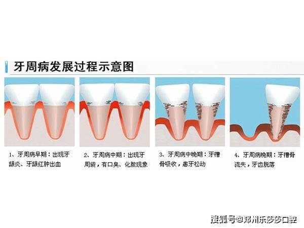 但是严重牙周问题的患者是无法做矫正的,先要进行牙周的治