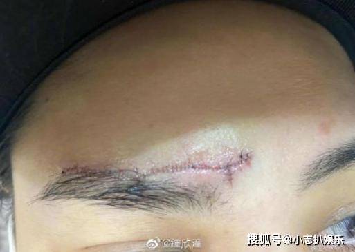 自己用针线缝伤口 9854f987fb0548ce93958d4b4841f853.jpeg