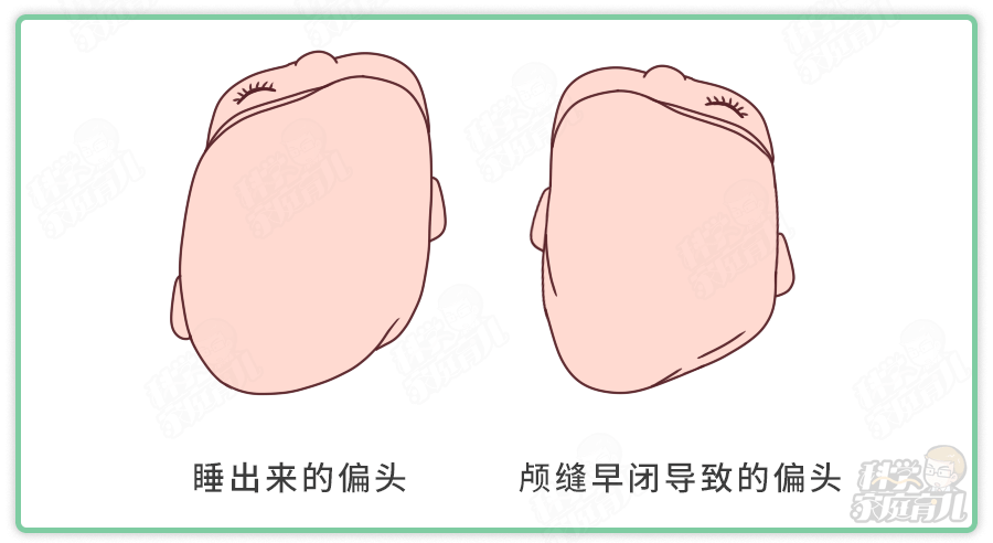 原创娃偏头,扁头?专家:抓住矫正"黄金期"