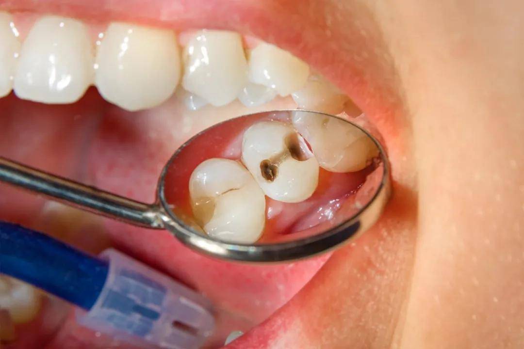 我是来补牙的,为什么牙洞却越补越大呢?