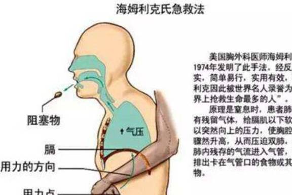 急救法|紧急时刻能救命！萌宝被异物卡住怎么办？教你海姆立克急救法