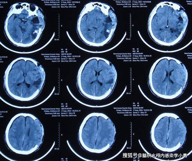 车祸脑外伤脑积水性脑膨出外院7个月内4次住院治疗后脑积水脑膨出无