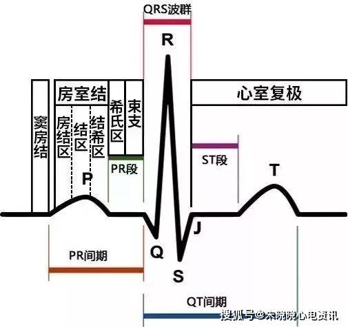 简易图解急性心梗的心电图演变_手机搜狐网