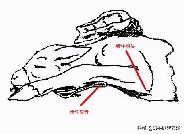 一,肘关节屈曲(elbow lock posture) 即未充分舒展的肘头被骨盆卡住