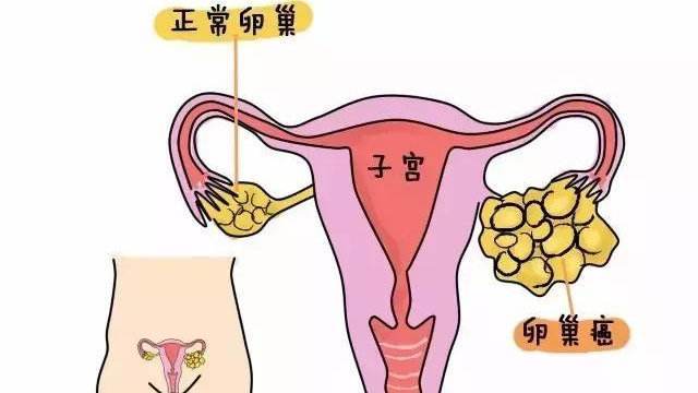 卵巢囊肿17厘米怎么办