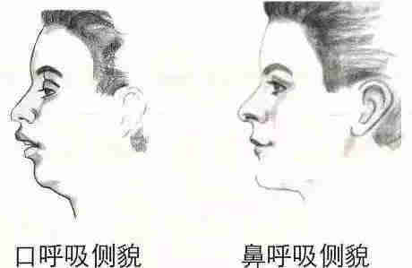 口呼吸是什么?