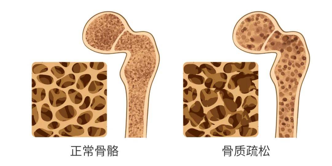 世界骨质疏松日 预防骨质疏松"要从娃娃抓起,这是真的!