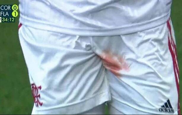 华体会体育官网_*
疼疼疼！男子的梦魇！球员被踩伤睾丸 血染球裤(图1)