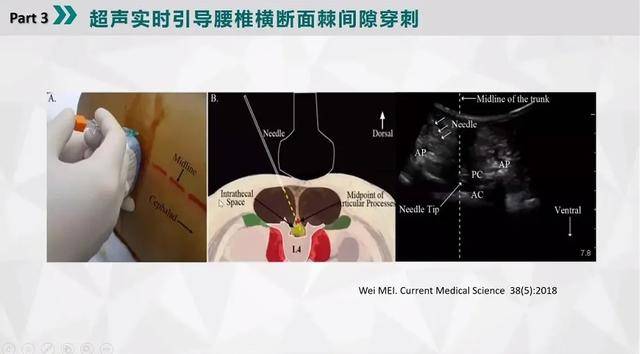 超声实时引导腰椎横断面棘突间隙穿刺